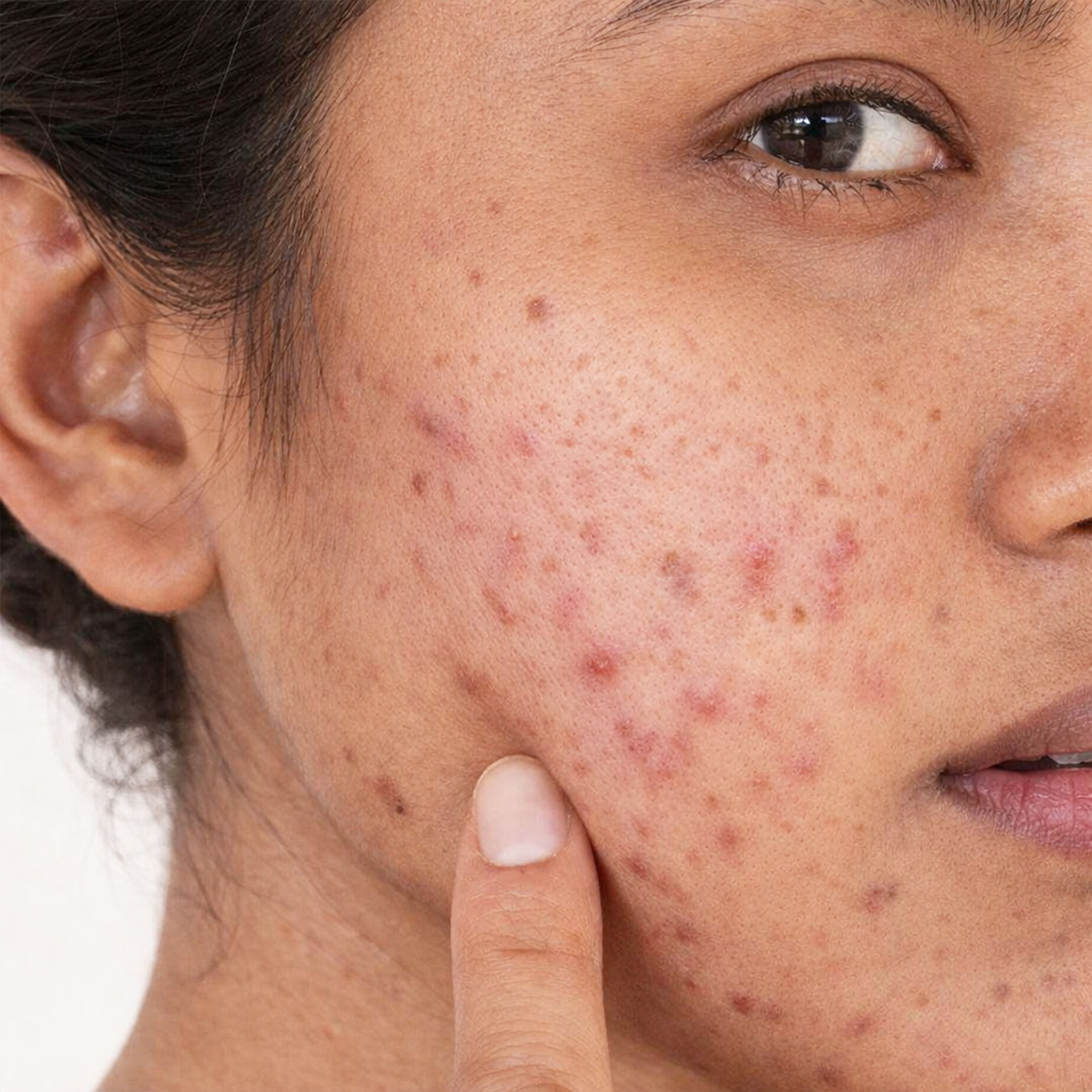ACNE 